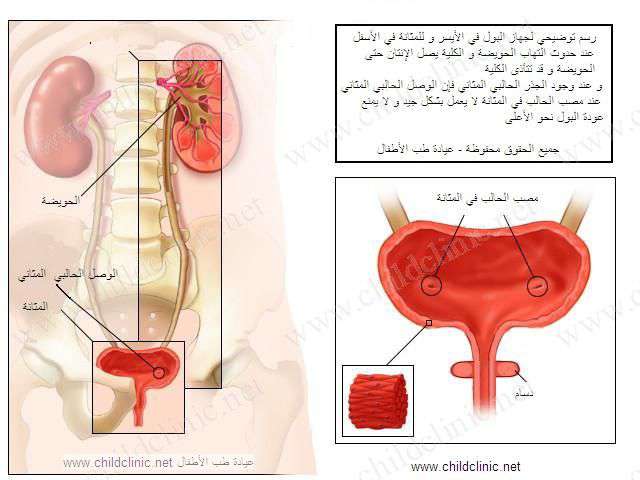 خطورة التهاب البول على الجنين , والوقاية منه