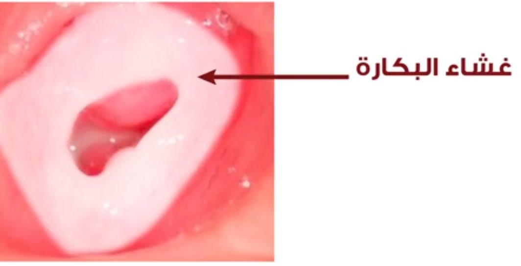 غشاء البكارة عند الاطفال - متى يتكون غشاء البكاره عند الاطفال 15781 6