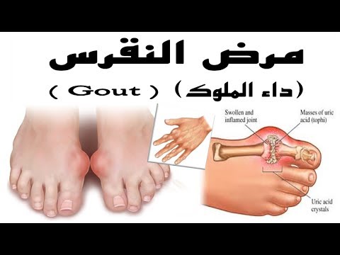 مرض النقرس , اهم اعراض واسباب مرض النقرس