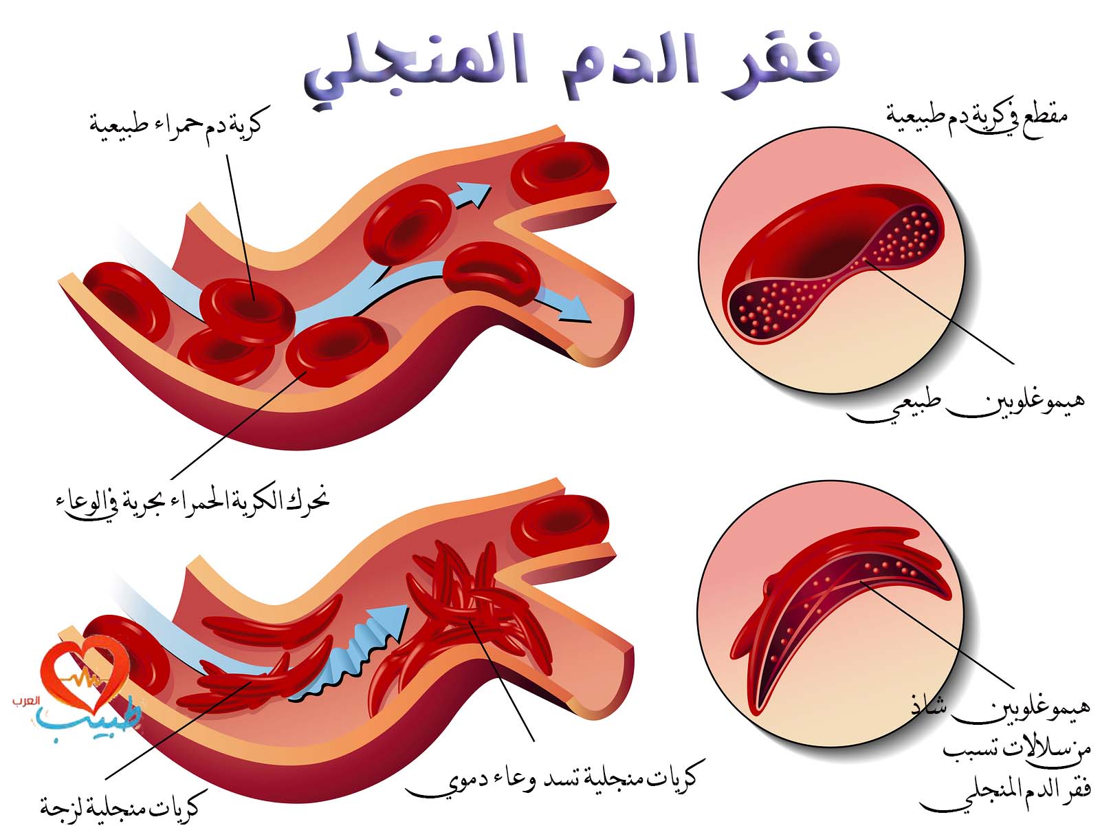 مرض فقر الدم - انيميا فقر الدم 5578 1