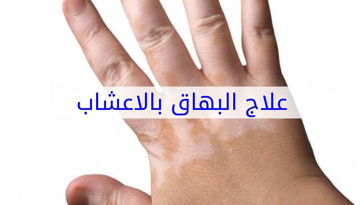 علاج البهاق بالاعشاب - طريقة فعالة في علاج البهاق بالاعشاب 579 3