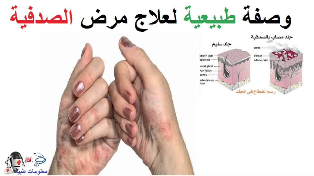 مرض الصدفية , ماهي اسباب وعلاج مرض الصدفيه