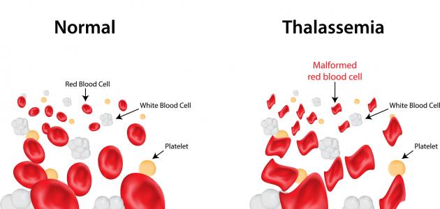 مرض الثلاسيميا - ماهو مرض الثلاسيميا و كيفية علاجه 4456 1