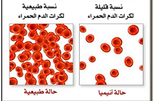 مرض فقر الدم - انيميا فقر الدم 5578