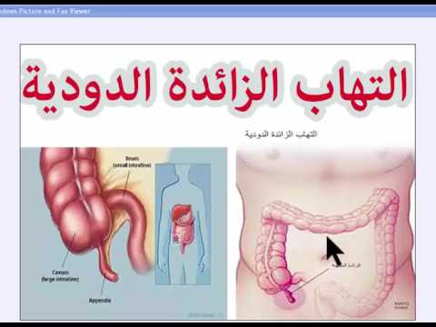 الزائدة الدودية - اعراض الزائده الدوديه 1171 1