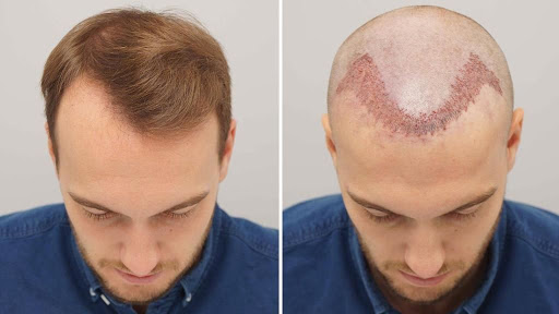 تكلفة زراعة الشعر في تركيا , اسعار زراعة الشعر في تركيا