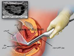 اعراض تكيس المبايض , الاسباب المسببه لمرض كسل المبايض عند السيدات