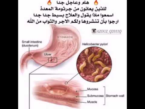 جرثومة المعدة وعلاجها - اعراض جرثومة المعدة والوقاية منها 16049 1