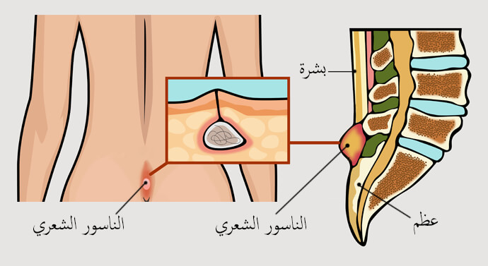 ما هو الناسور , تعرف على أعراض هذا المرض