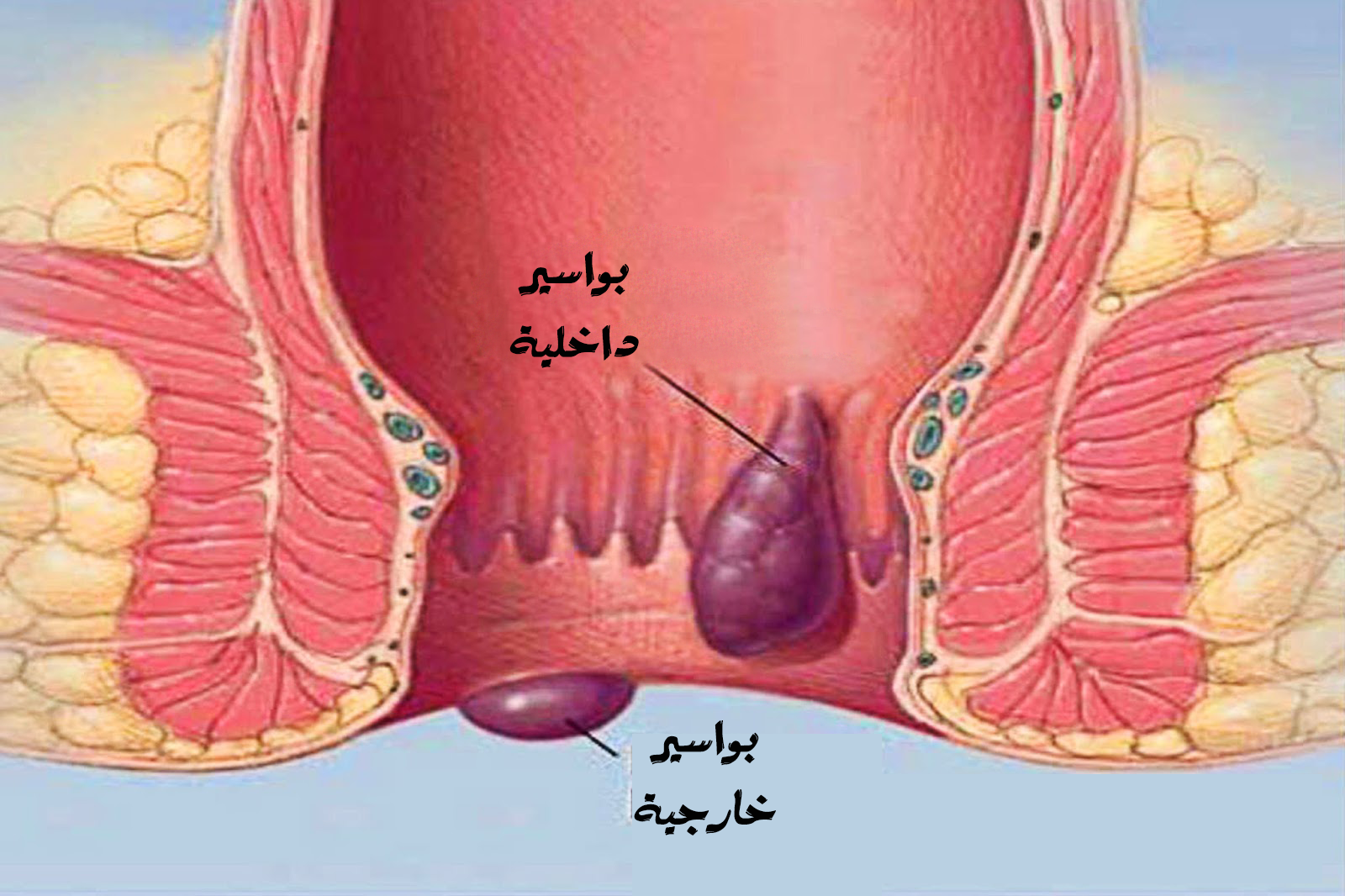 علاج البواسير - افضل علاج للبواسير بالليزر 3665 1