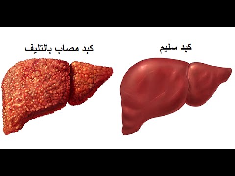 علاج تليف الكبد - التعافى من تليف الكبد 5611 2