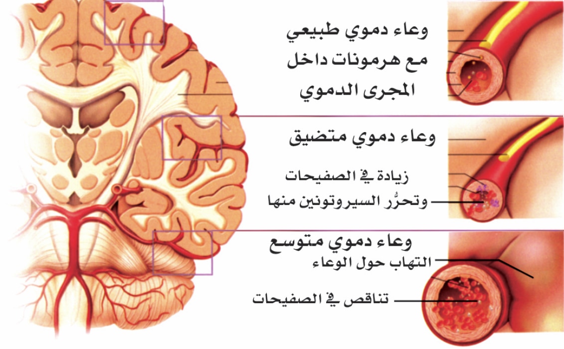 مرض الشقيقة 5943 1