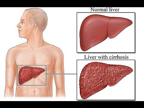 علاج تليف الكبد - التعافى من تليف الكبد 5611 1