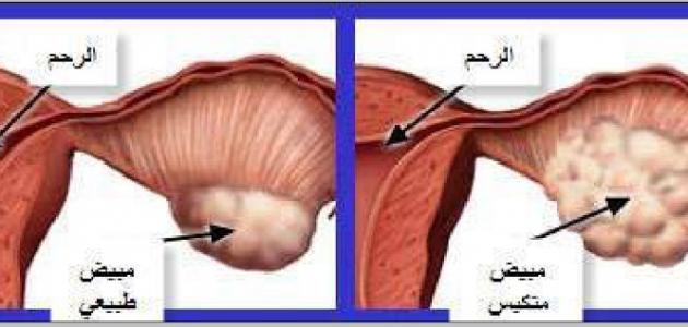 ماهي اعراض تكيس المبايض , كل شئ عن تكيس المبايض