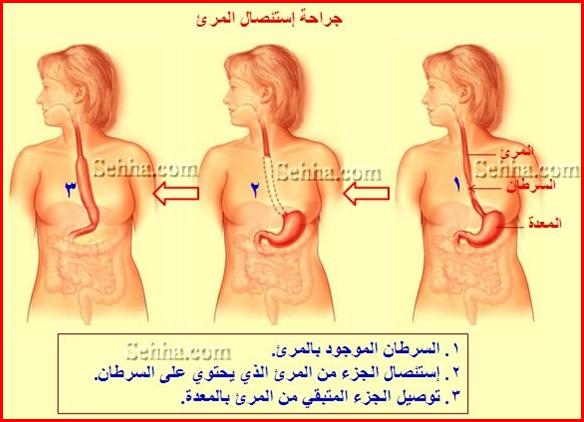 اعراض سرطان المريء , كيفيه الاصابه بسرطان المرئ