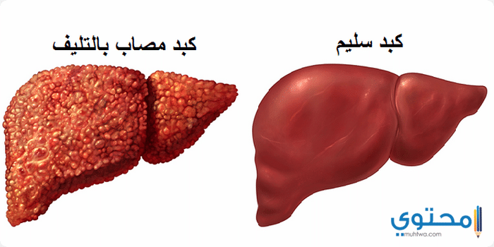 علاج مرض السرطان - علاج مرض السرطان وحله 2314