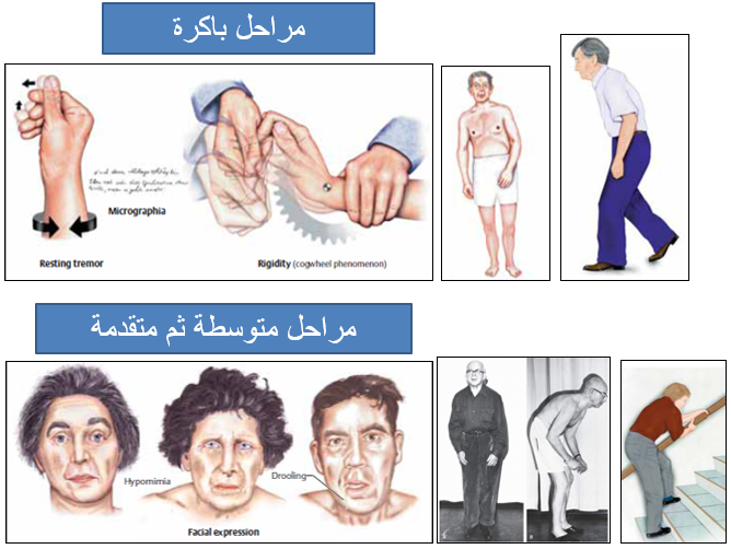 مرض باركنسون - شاهد اعراضه مرض باركنسيون و كيفيه علاجه 3646