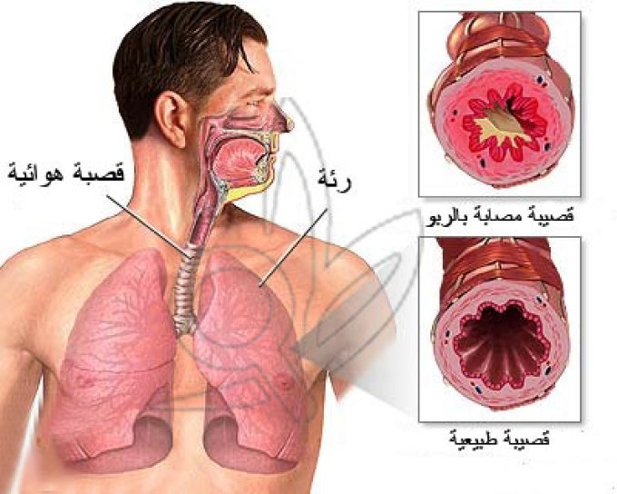 مرض الربو , اعرف اكثر عن الربو