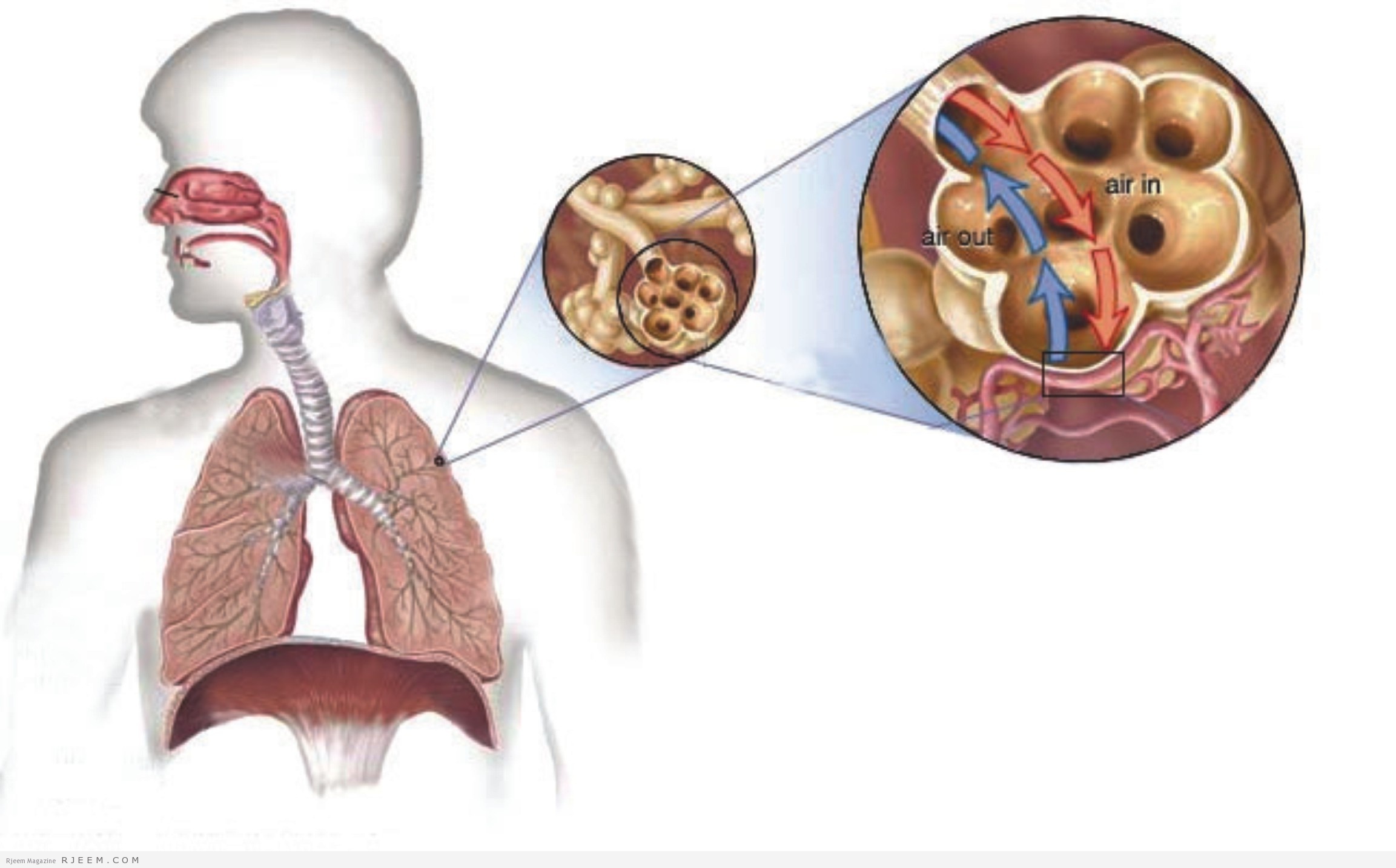 علاج مرض السل - السل وطريقة علاجه والوقاية منه 642 3