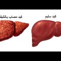 5611 2 علاج تليف الكبد - التعافى من تليف الكبد هنادي منير