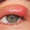 1865 3 علاج حساسية العين - وصفات لعلاج حساسية العين ايمان
