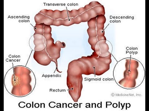 ماهي اعراض سرطان القولون , الوقاية من السرطان والحفاظ على الجسم منه